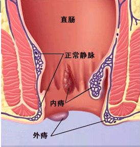 苏州肛肠医院 肛肠科 痔疮 外痔 >> 导致外痔的原因是什么  ★★ 导致