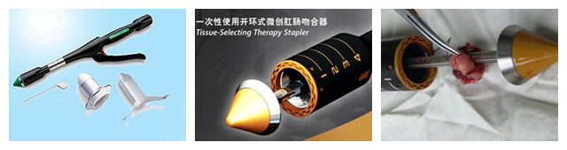 混合痔手术治疗方法有哪些