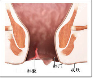 引发肛裂的原因有哪些