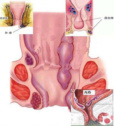 苏州外痔的类型及其表现