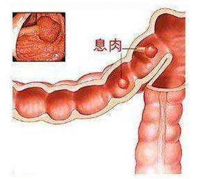 肠息肉怎么引起的