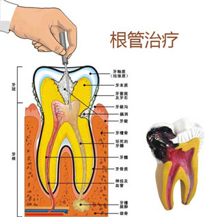 牙齿根管治疗后为什么要带牙套？