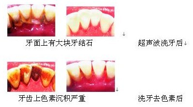 超声波牙齿美白术后护理怎么做?