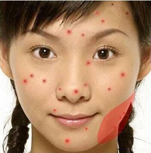 为什么皮肤老是长痘？