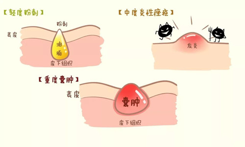 酒渣性痤疮易患人群有哪些