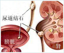 苏州治疗尿道结石哪里好？