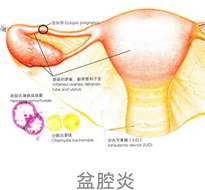 长期腹部坠痛是盆腔炎的症状吗