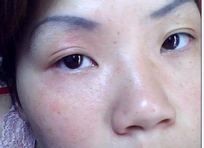 3岁小朋友吃海鲜 身上过敏 起小疙瘩 痒 小疙瘩好像越_脾气网 3岁小朋友吃海鲜 身上过敏 起小疙瘩 痒 小疙瘩好像越抓越多 药店的医生说是荨麻疹 怎么治疗好啊 。。(图2) 3岁小朋友吃海鲜 身上过敏 起小疙瘩 痒 小疙瘩好像越抓越多 药店的医生说是荨麻疹 怎么治疗好啊 。。(图5) 3岁小朋友吃海鲜 身上过敏 起小疙瘩 痒 小疙瘩好像越抓越多 药店的医生说是荨麻疹 怎么治疗好啊 。。(图8) 3岁小朋友吃海鲜 身上过敏 起小疙瘩 痒 小疙瘩好像越抓越多 药店的医生说是荨麻疹 怎么治疗好啊 。。(图11) 3岁小朋友吃海鲜 身上过敏 起小疙瘩 痒 小疙瘩好