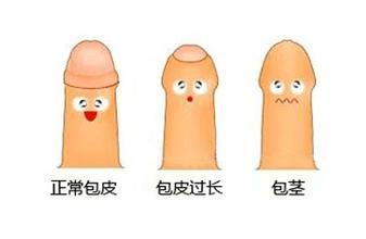 苏州包皮过长治疗医院
