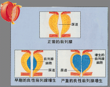 苏州治疗前列腺增生医院
