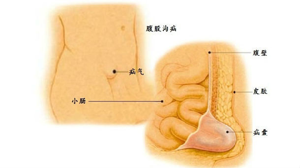 苏州治疗疝气医院