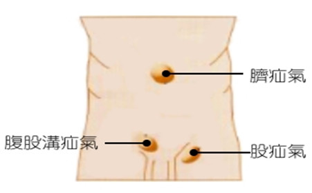 苏州治疗疝气医院