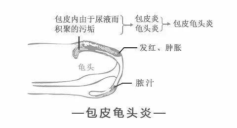 苏州治疗包皮龟头炎